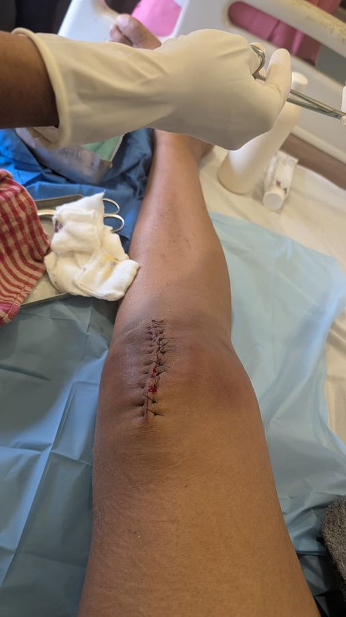 Surgery. Stitches. A new starting line.